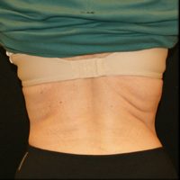 CoolSculpting