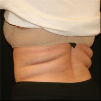 CoolSculpting