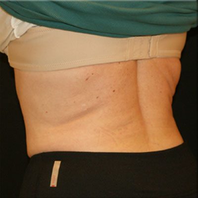 CoolSculpting