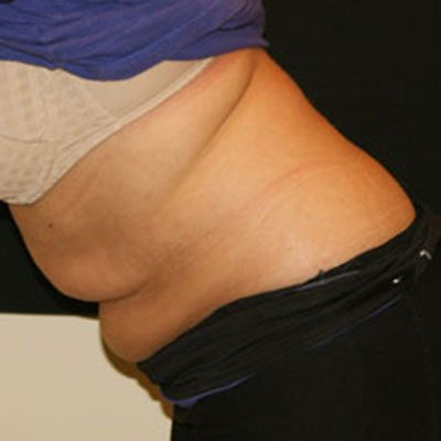 CoolSculpting Case 1509 Before Photo CoolSculpting