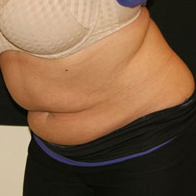 CoolSculpting Case 1509 Before Photo CoolSculpting