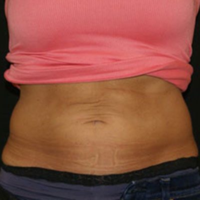 CoolSculpting Case 1509 After Photo CoolSculpting