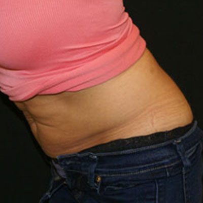 CoolSculpting Case 1509 After Photo CoolSculpting