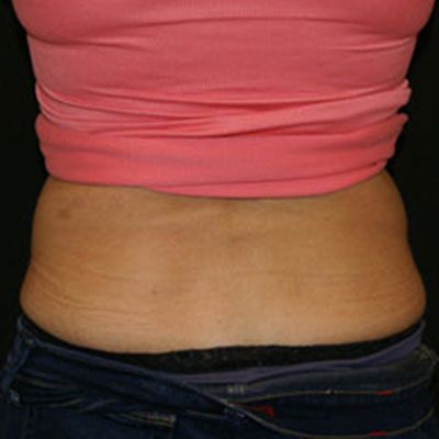 CoolSculpting Case 1509 After Photo CoolSculpting