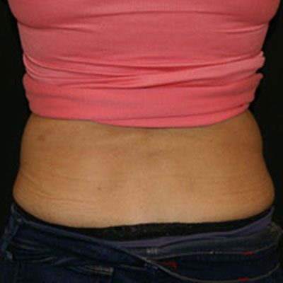 CoolSculpting