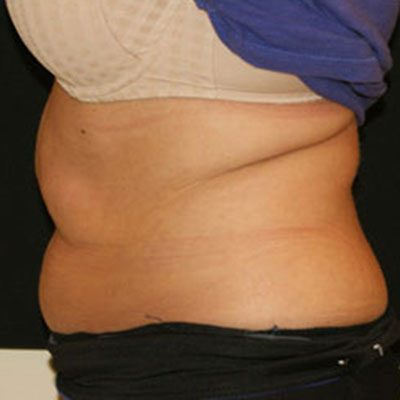 CoolSculpting Case 1509 Before Photo CoolSculpting