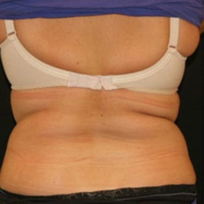 CoolSculpting Case 1509 Before Photo CoolSculpting