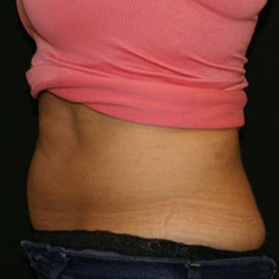 CoolSculpting Case 1509 After Photo CoolSculpting