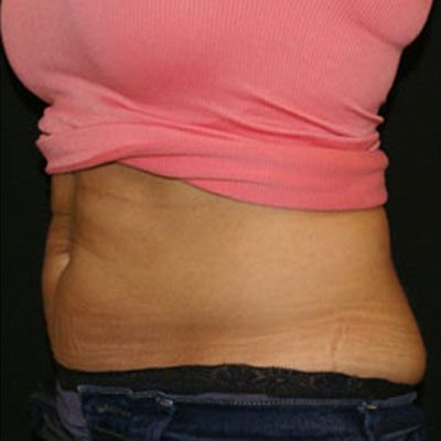 CoolSculpting Case 1509 After Photo CoolSculpting
