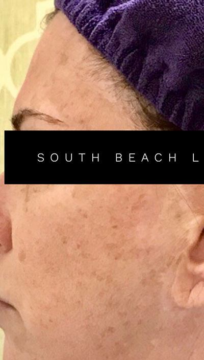 South Beach Peel Results St. Louis