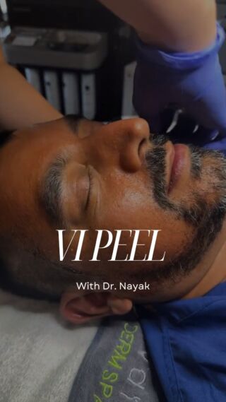 ✨Come along for a VI Peel with @nayakplasticsurgery and Jenna at @avanidermspa 🤗🧖🏾‍♂️

Benefits of the @vipeel include 

✅reduced appearance of age spots
✅reduced appearance of fine lines and wrinkles 
✅brightened discoloration
✅improved appearance of texture and tone 
✅improved acne scarring 
✅stimulates collagen 

🟢cost of the VI Peel is $350 in office and often a series is recommended for best results 

🟢peeling/shedding starts 3-5 days post peel and takes about a week to resolve 

🟢must be very about sun exposure post-peel and diligent with sunscreen 

🟢consultations with our talented estheticians are complimentary! 

To schedule or for questions:

➡️ call/text: 314-991-5438
➡️ email: spa@nayak.net