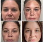 🍁🍂 With the first day of fall officially under our belt, we want to highlight another treatment that is great for pigment and fall is the perfect time to address these concerns! 🍂🍁

After treatment our patient states that "my skin has never looked better” 

👏👏WE LOVE TO HEAR IT 👏👏

😎 Treatment: IPL Photofacial

🌈 IPL: Treats uneven skin tone and stimultates collagen production! Optimal typically take 2-4 treatments, but, you'll see improvement right from the first session! 

⏱ Quick In-Office Procedure: Our laser specialists work their magic in just 15-30 minutes. You might experience some redness, but that's nothing a little makeup can't handle. 💄 Most folks are back to their daily grind right after treatment. Watch those pigment spots rise to the surface over 1-10 days and gracefully flake away. It's like a mini makeover right on your skin! 

Ready to fall in love with your skin this season? 🍁 Schedule your IPL Photofacial today and let's glow together! 💁‍♀️ Text 314-991-5438 or email spa@nayak.net to schedule a consult or to inquire!