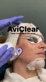 💥Let’s talk 𝐀𝐯𝐢𝐂𝐥𝐞𝐚𝐫 for mild to moderate acne!💥

☕️The tea? AviClear is the first and original FDA-cleared energy device for the treatment of mild to severe acne. Nayak Plastic Surgery & Avani Derm Spa are pleased to be the first provider in St. Louis to offer this amazing treatment!

⚡️How does it work? Acne emerges when sebum, the oily substance present on your skin, mixes with dead skin cells and obstructs your pores. Many acne treatments address various contributors to acne, however, they often overlook the regulation of sebum production. AviClear utilizes a 1726 nm wavelength to address acne at its root, precisely focusing on and reducing activity in the sebaceous gland in a safe and efficient manner. This eradicates acne at its origin and without the need for prescription medication! Engineered to prioritize patient well-being, AviClear incorporates AviCoolTM contact cooling, ensuring an ideal and secure treatment process.

🙋‍♀️Who is a candidate? Those with mild to moderate acne

🧖‍♀️What is treatment like? Three treatments are performed spaced 4-6 weeks apart.

💲What is the cost? The total cost for treatment is $3,300

🗣️What are patients saying? Results from clinical trials indicate that after undergoing the AviClear procedure, both existing and potential future acne breakouts become briefer, milder, and less frequent. Additionally, the effectiveness of this innovative treatment becomes more pronounced over time, underscoring its enduring impact on acne clearance.

We would love to help you say goodbye to your acne!!

To inquire/schedule ⬇️⬇️⬇️
📧Email spa@nayak.net 
📱text/call 314-991-5438