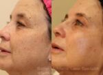 🍂🍁 More fall IPL magic! 🍂🍁

We are continuing our fall pigment journey! Just one IPL treatment and our patient is absolutely thrilled with the results! Our laser specialist, @brittlynrose2 , worked her magic to erase years of unwanted sun damage in a single session.

IPL (Intense Pulsed Light) therapy is your secret weapon for tackling age spots, sun spots, birthmarks, freckles, and enhancing your skin's overall texture with the added benefit of collagen stimulation!!

Do you have unwanted pigment that you want help with?!? 🍂🍂 Text us at 314-991-5438 or drop us an email at spa@nayak.net to schedule your complimentary consultation!